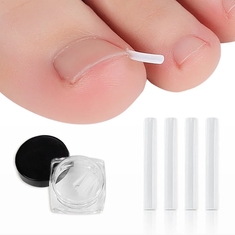

Orthodontic Device Ingrown Pad Nail Groove Toenail Long Flesh Padding Orthodontic Toenail Padding 30 pcs для ногтей