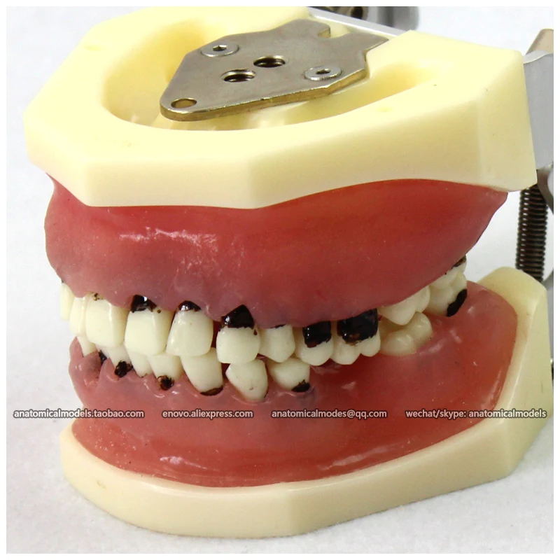 

12610 / Oral Flap Surgery Severe Periodontal Disease Model , Medical Science Educational Teaching Anatomical Models