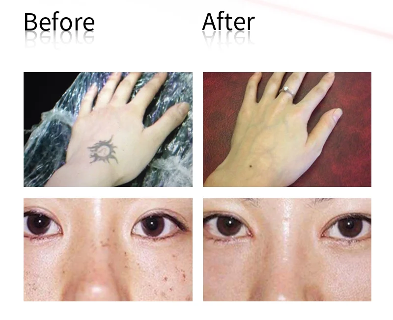 Пикосекундная ручка черная татуировка для удаления рубцов от акне крот Веснушка