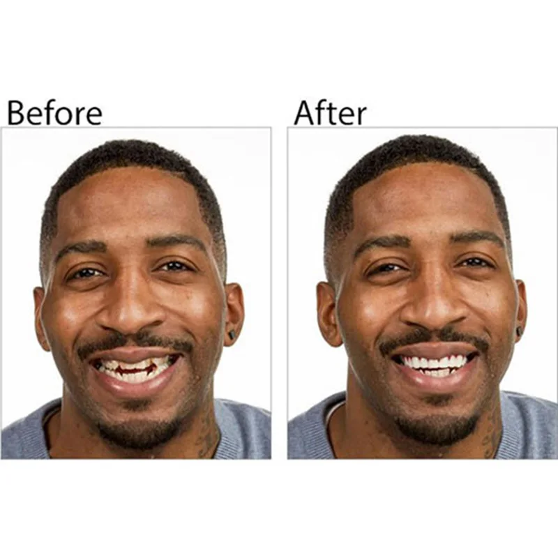 Профессиональный Идеальный улыбка Фанера Dub в наличии для коррекции зубов плохие