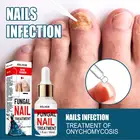 50 мл раствор для ухода за ногтями, онихомикоз, Лечение грибка ногтей, уход за ногами, восстанавливающий раствор, антиинфекционная сыворотка паронихии