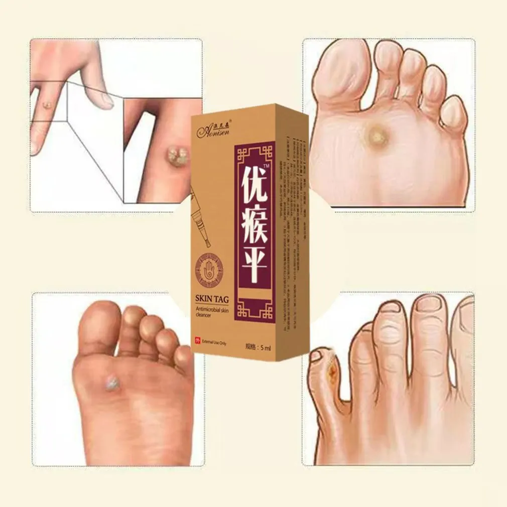 Средство для удаления бородавок папилломы Быстрое Удаление родинок