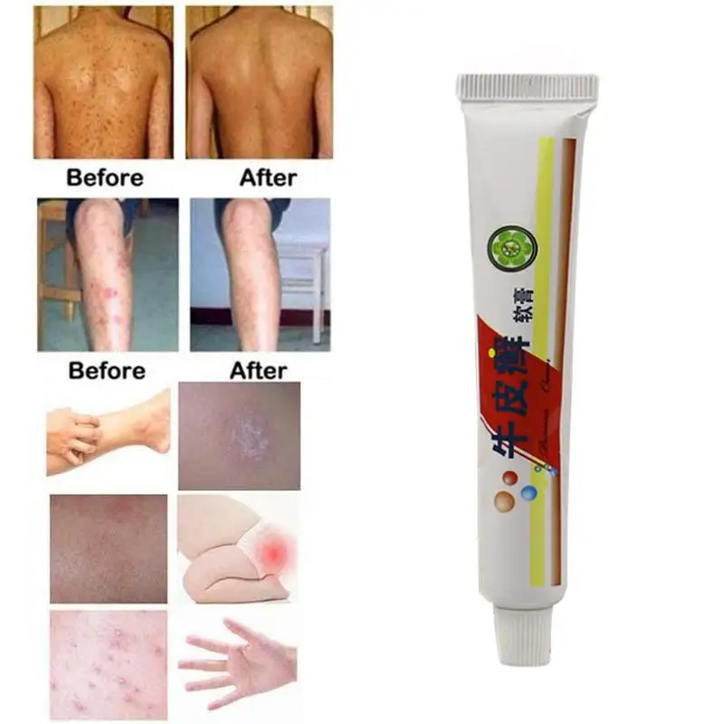 1pc Dermatologist Skin Ringworm King Ointment Genuine Psoriasis Sweat Spot Chinese Medicine Care | Красота и здоровье