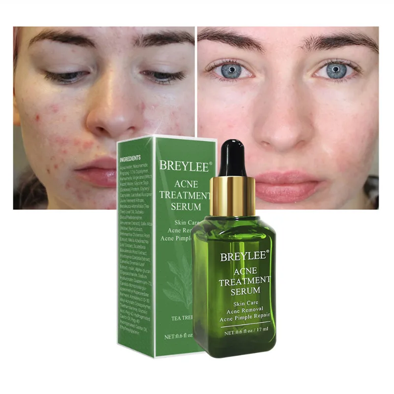 BREYLEE акне лечебная сыворотка уход за кожей Отбеливающий Восстанавливающий