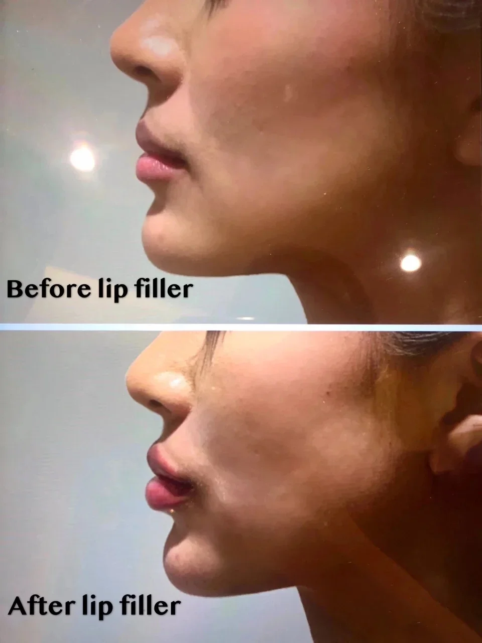 

2ml/5ml/10ml Lip Filler Injections Cross-linked Enlarged Lip Lifting Injector Hyaluronic Acid Lip Filling For Hylauron Acid Pen