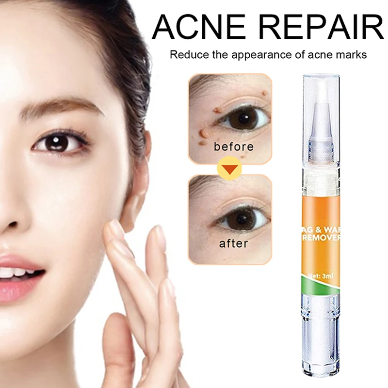 

Tags and Moles Remover Skin Gently Rejuvenate