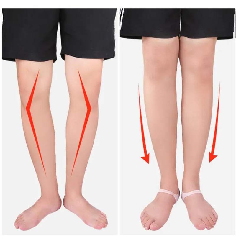 

2pcs O-type Foot Corrector Insoles Pads No Slip Shoes Cushion For Men And Women Silicone Orthopedic Insoles Flatfoot Foot Care