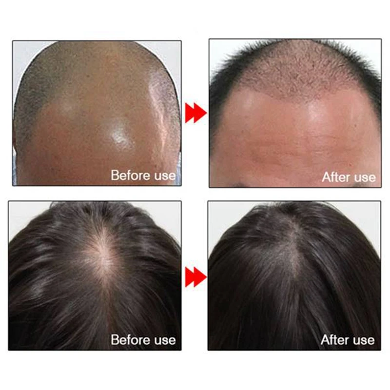 

ARTISCARE 5 Pcs 20Ml Hair Growth Essential Oil Hair Regrowth Serum