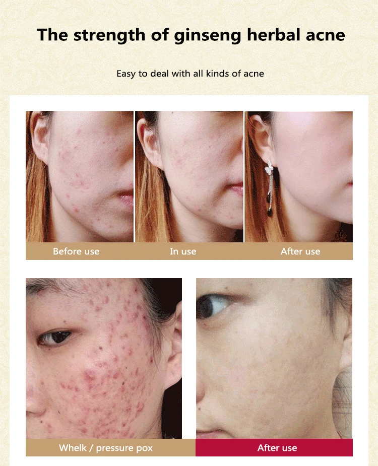 Herbal Acne Remove Pimple Oil-control Serum Shrink Pores Fade Printing and Repair Face Centella Blain Serum Skincare TXTB1