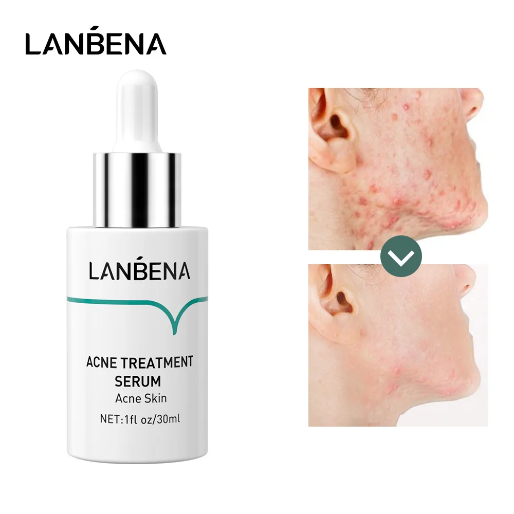 

LANBENA Acne Treatment Serum Oilgopeptide Anti Acne Solution Reduce Mark Shrink Pores Deep Repair Strengthen Skin Bottom 30ML