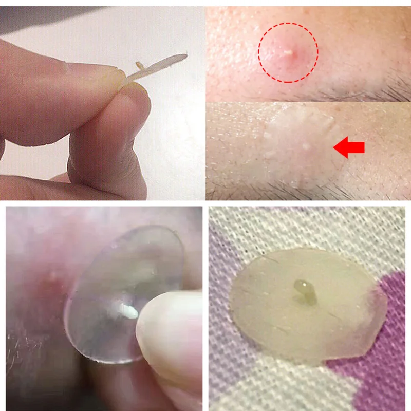 36 шт. Патчи от акне лечение и уход за кожей лица мастер прыщей средство для