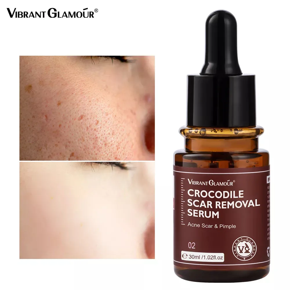 

VIBRANT GLAMOUR Scar Removal Serum Acne Gel Stretch Marks Surgical Scar Burn Body Pigmentation Corrector Acne Spots Repair Care