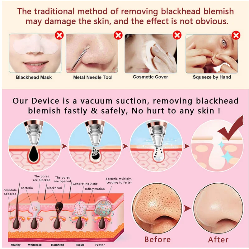 Электрический вакуумный пылесос для очистки лица удаление черных точек машина