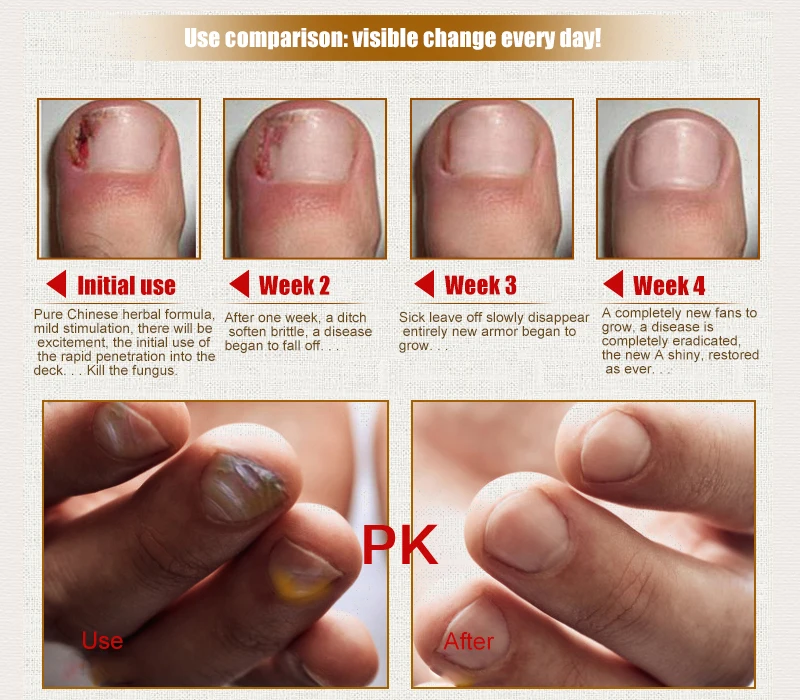 1 шт. 30 мл эффективный грибковый гель для ногтей на ногах лечение трав эссенция