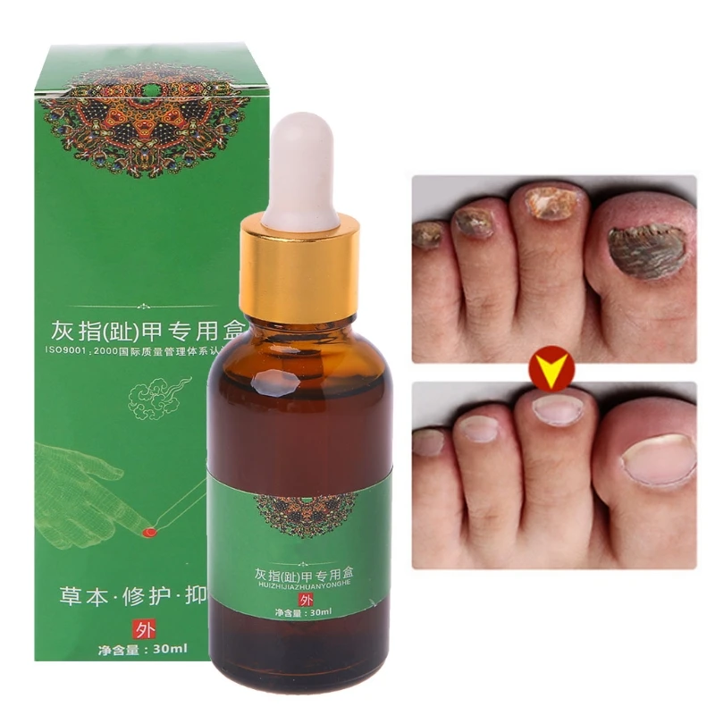 

Fungal Nail Treatment Essence Repair Toe Nails Finger Anti Fungus Infection 30ml