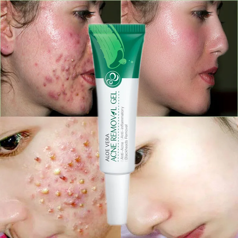 

Face Cream Serum Anti Acne Scar Cream Shrink Pores Moisturizing Oil Control Soothing Essence Skin Care Aloe Acne Treatment Gel