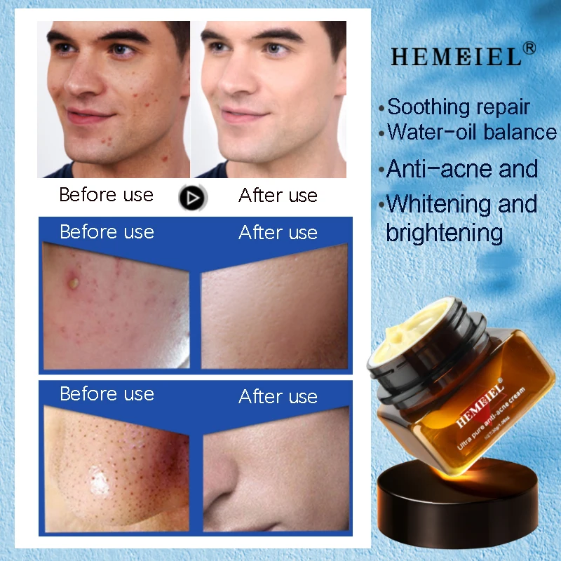 

HEMEIEL 30G Men's Anti-acne Oil-control Face Cream Plant Essence Glycyrrhiza glabra root Extremely Pure Acne Repellent Skin Care