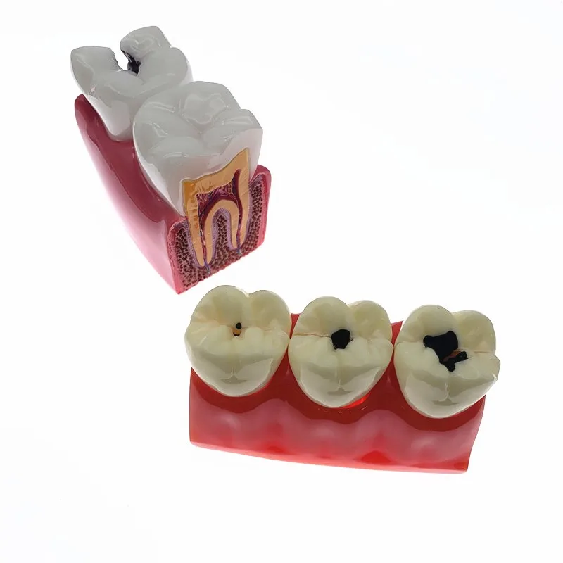 Модель сравнения зубов 4 раза/6 раз демонстрация обучения стоматологии |