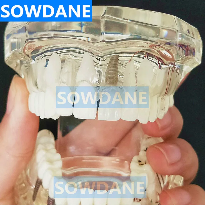 Модель зубного имплантата с мостиком для восстановления зубов стоматолог