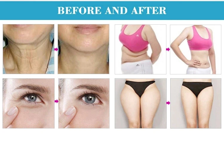 Горячая антицеллюлитная V shape 3 Syneron Vela shape Iii V9 Iii Syneron Vela shape машина для продажи