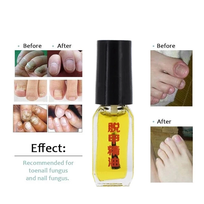 

3PCS Removal of fungus essence fungus nail treatment bright nail repair anti-infective foot care onychomycosis