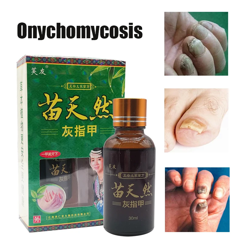 

30ML Herbs Fungal Nail Treatment Essence Serum Repair Toe Nail Fungus Removal Gel Anti Infection Paronychia Onychomycosis