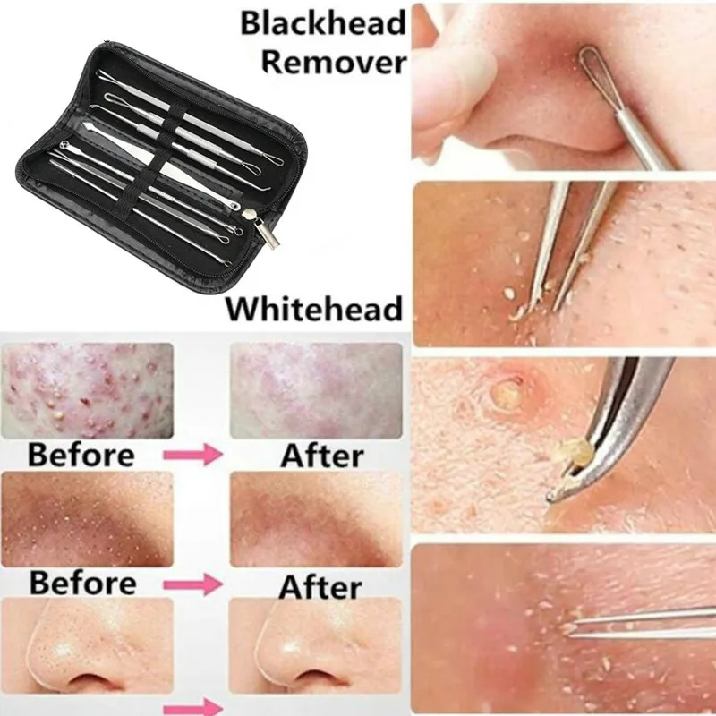 3 4 5 7 8 Pc Stainless Steel Blackhead Remover Tool Kit Face Massage Whitehead Pimple Spot Comedone Acne Extractor Face Massager