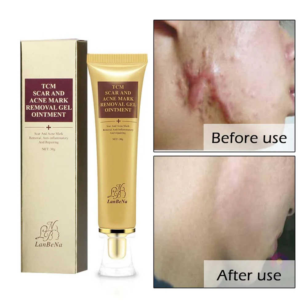 Lanbena крем для удаления шрамов от акне восстановления кожи лица и пятен лечение