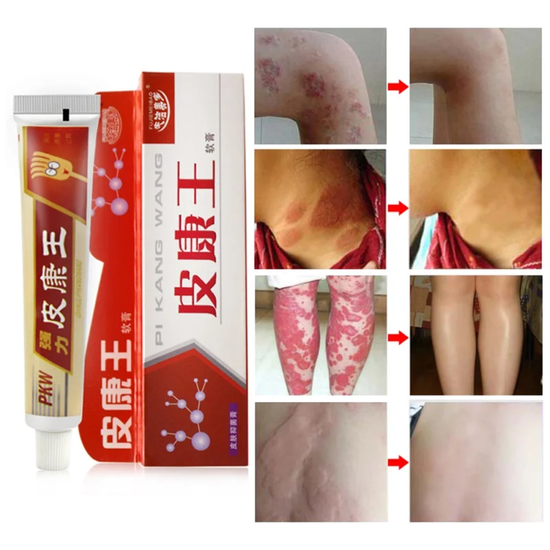 Полезно оригинальный псориаз дерматит экзема зуд проблемы с кожей крем для