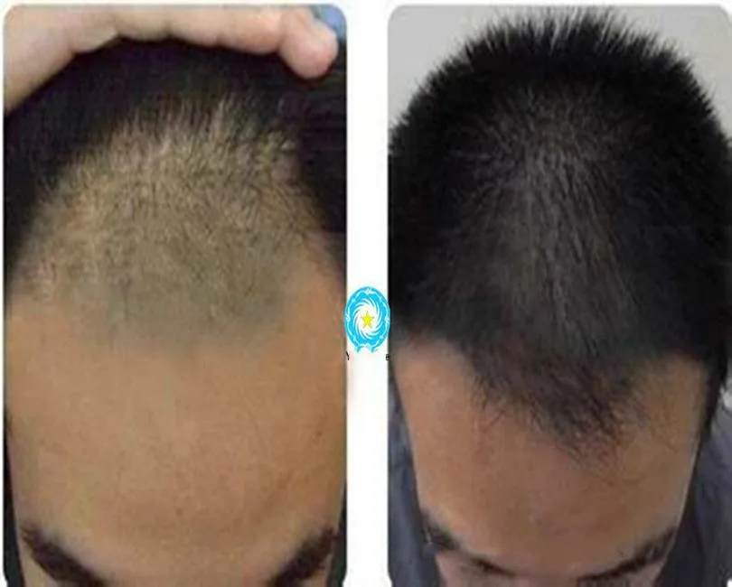 

50 мг трипептид, пептид для роста волос, косметический материал, против выпадения волос, способствует росту волос
