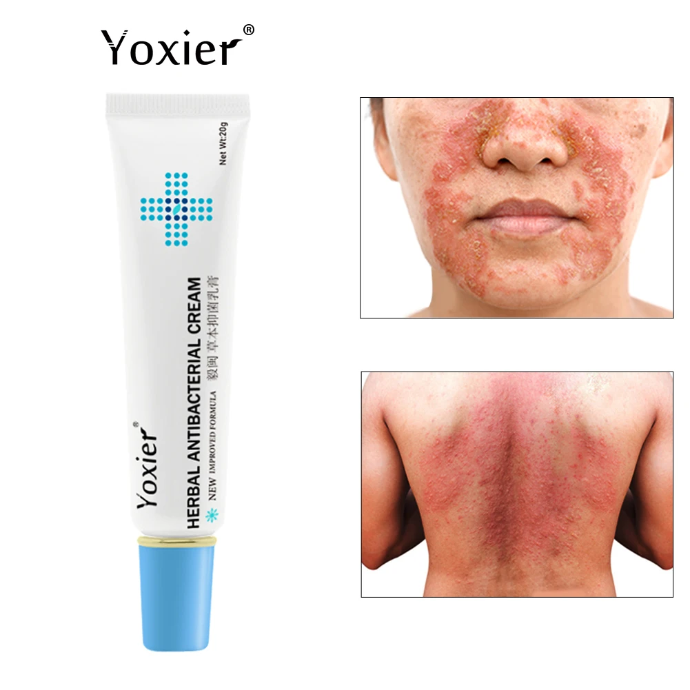 Антибактериальный крем от псориаза Yoxier лечение экземы крапивницы удаления зуда |