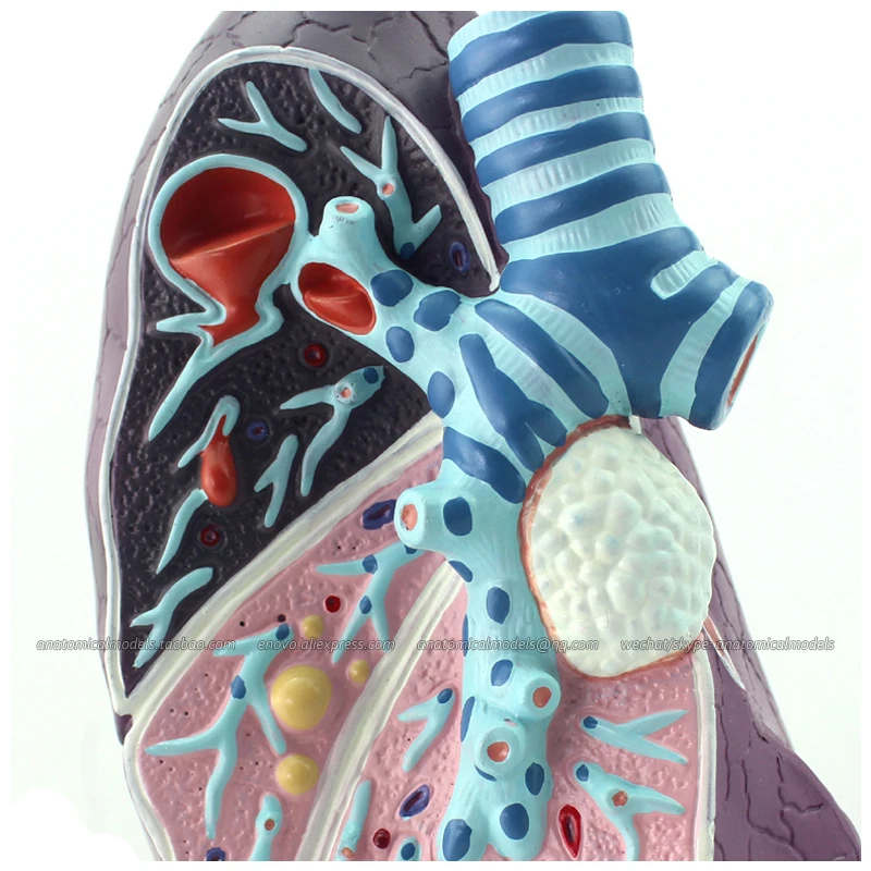 

CMAM/12501 Pathological Model of the Lung, 2/3x, Human Respiratory System Medical Teaching Anatomical Model