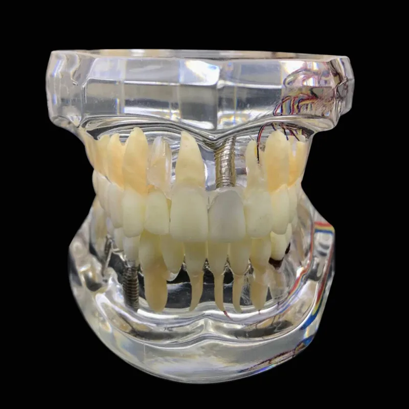 Стоматологическая реставрация зубов Модель с зубным нервом отсоединяемые зубы