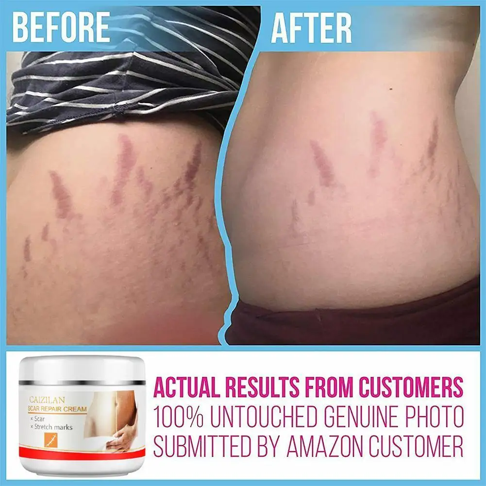 

Remove Pregnancy Scars Acne Cream Stretch Mark Treatment Treatment Skin For Stretch Mark Care Removal Cream Maternity Slack N1C3
