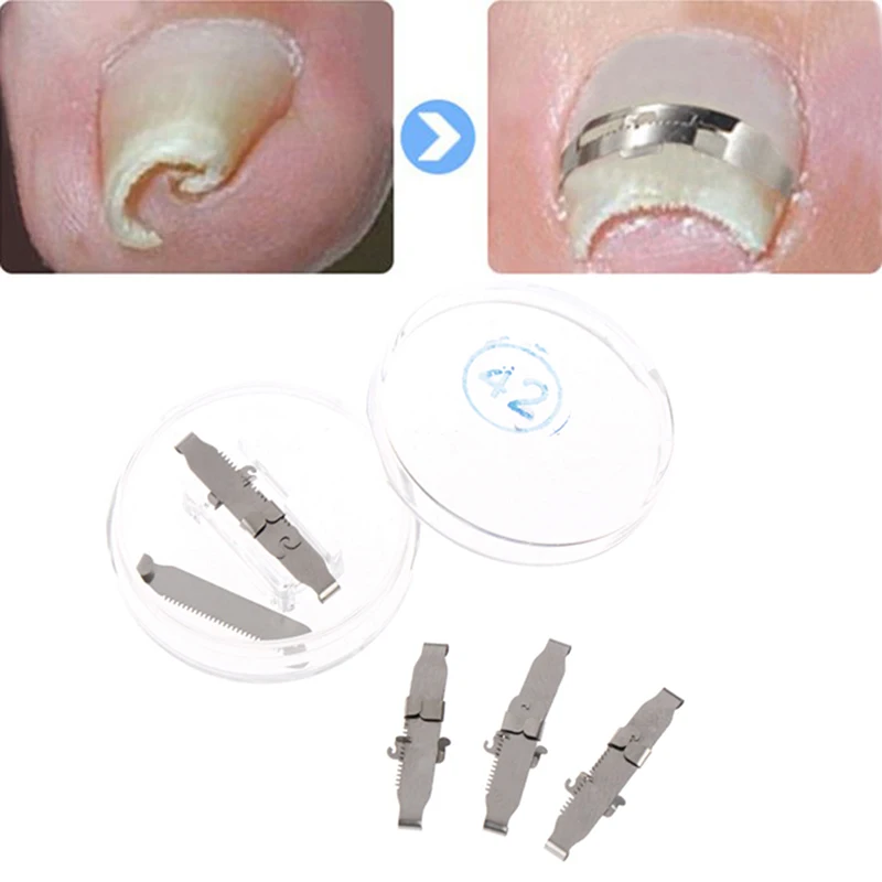 

Ingrown Toe Foot Nail Correction Fixer Nail Pedicure Tool Toenail Corrector New