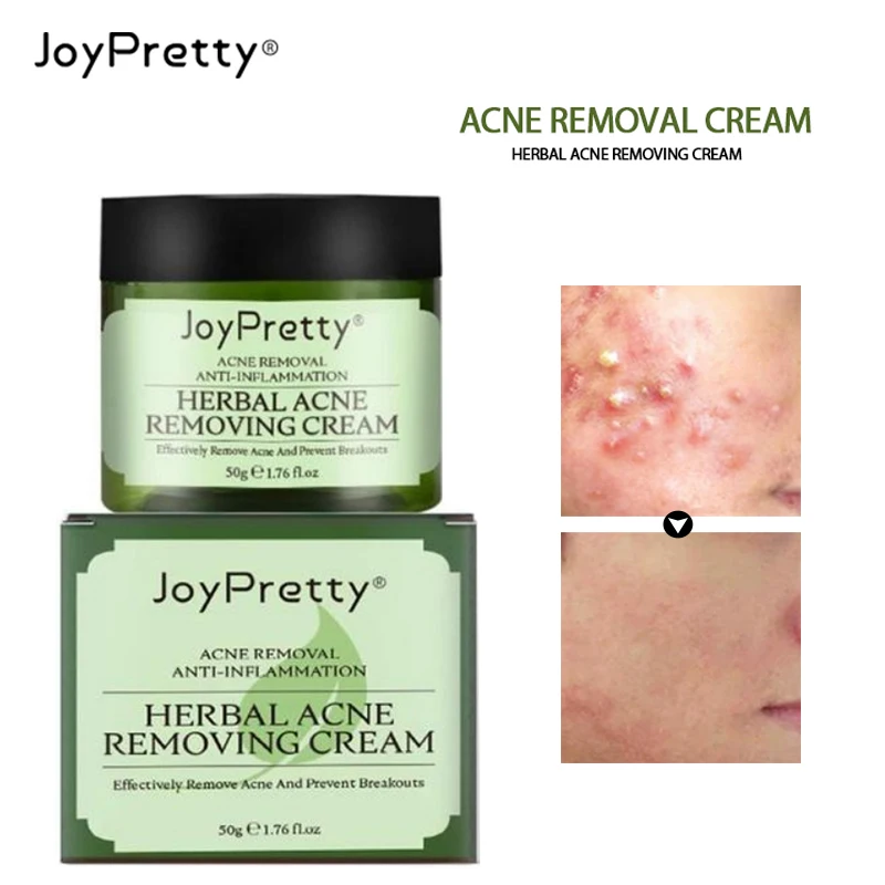 Отбеливающий крем для лица JoyPretty лечения акне пигмент удаления пятен увлажняющий