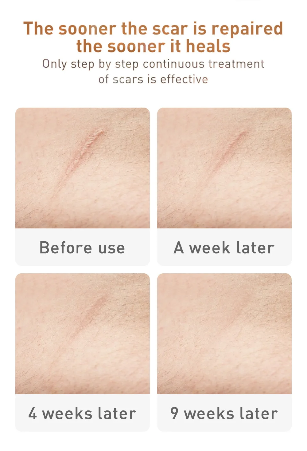 Крем для удаления шрамов от акне 30 г крем лица гель восстановления контроль