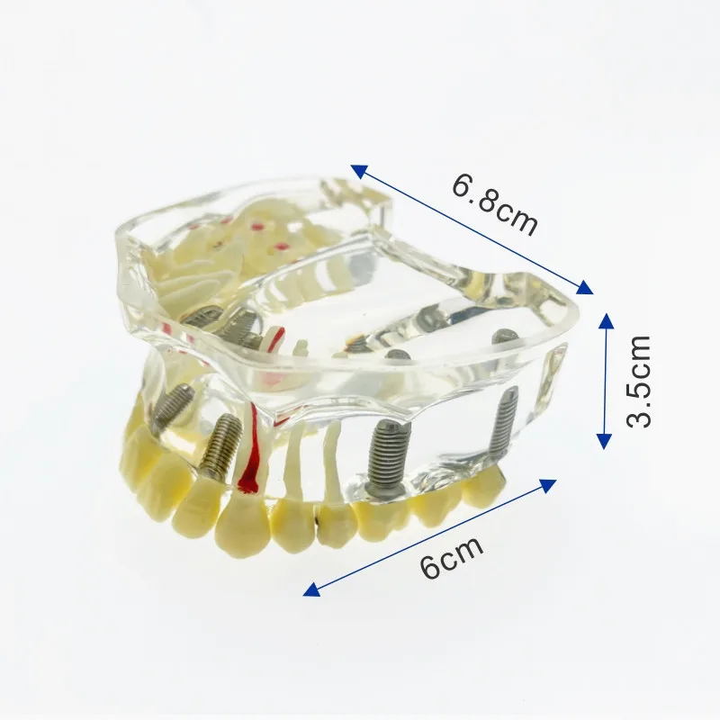 Модель зубного импланта с имплантатом и коррекцией кариес стоматологическое