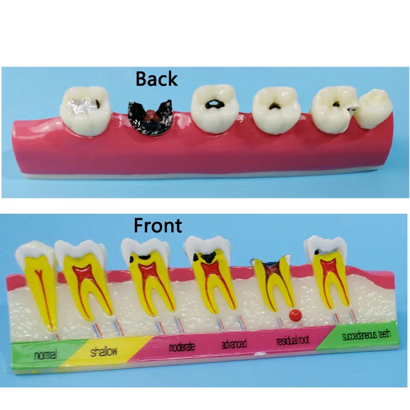 

Модель для классификации зубного кариеса, демонстрация моделей зубов, обучение обучению, модель для анализа зубов