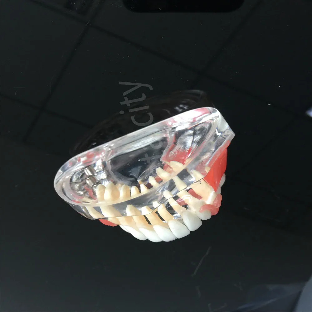 Модель имплантата для зубных протезов с сосудов демонстрация 6006 | Красота и