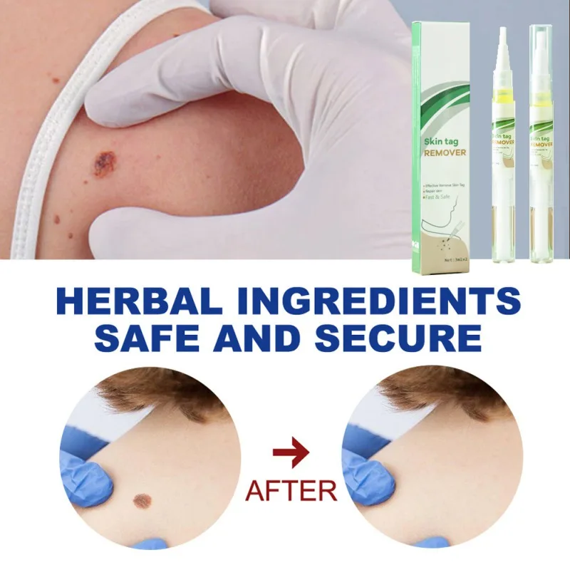 2 шт. бактериостатическая жидкость для удаления бородавок на ногах | Красота и