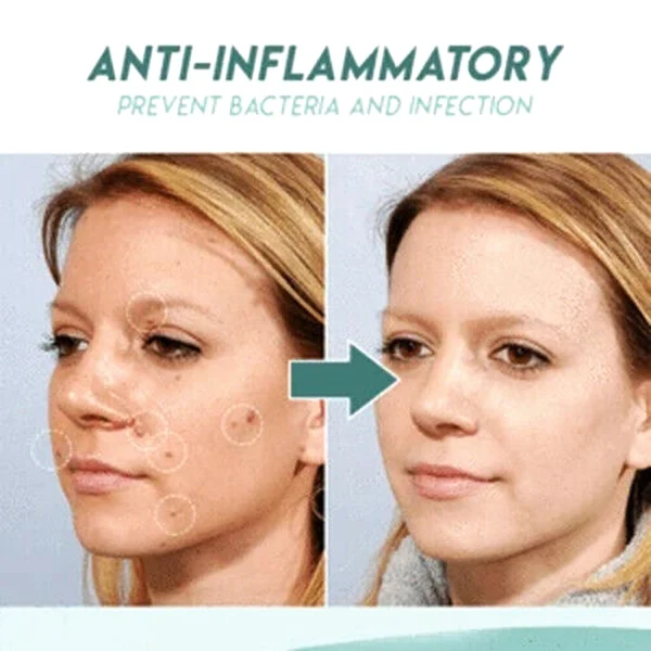 

Skin Tag Acne Master Patch Sticker Face Facial Skin Care Cover Safe Beauty Remover Pimple Protects Wounded Patch Treatment