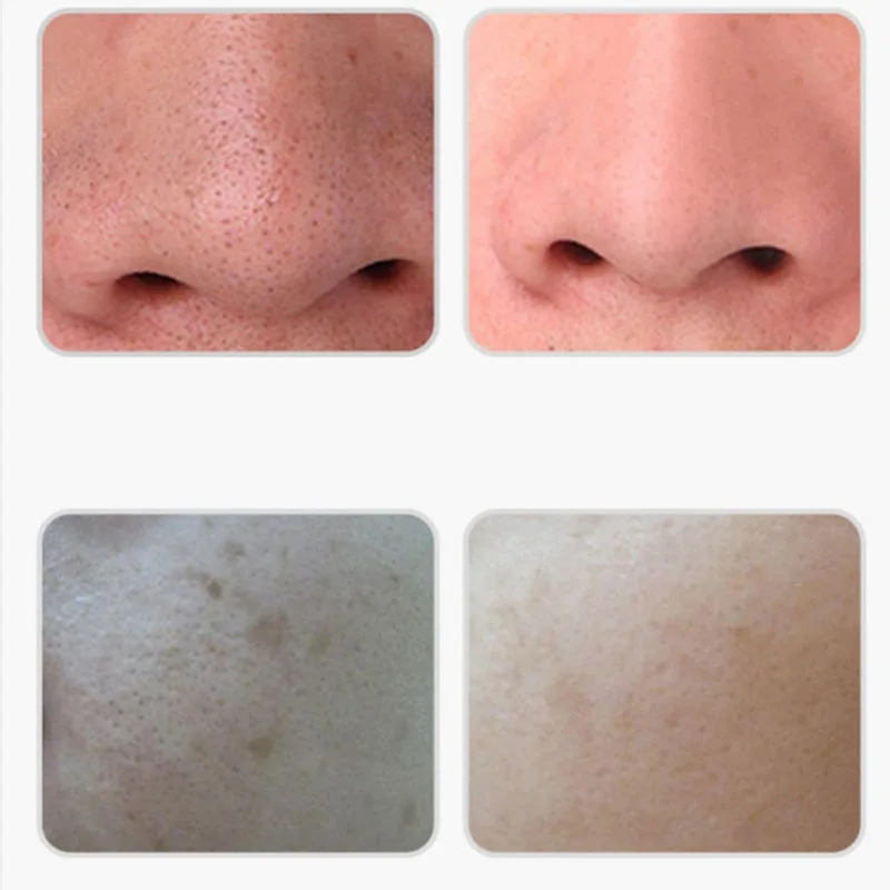 

Skin Scrubber Facial Ultrasonic Skin Scrubber Electric Peeling Shovel Pore Cleaner Face Lifting Thermal Care