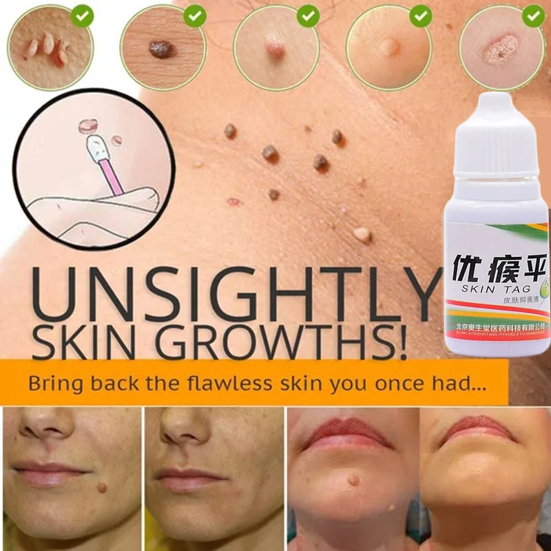 Средство для удаления рубцов на коже медицинская Жидкость против крот быстрое