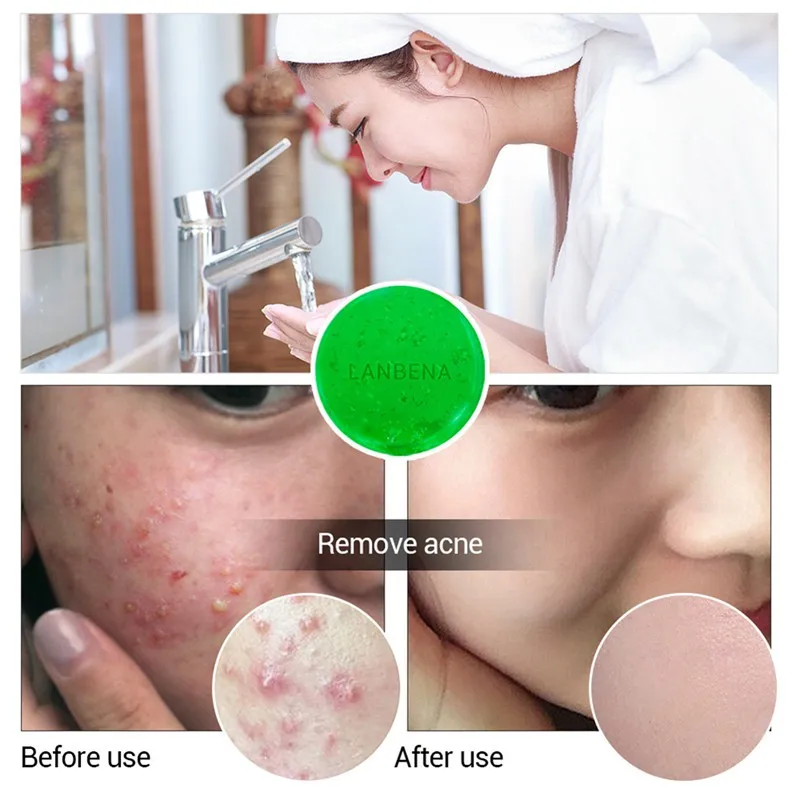 Натуральный чай искусственное кожу лица мыло с глубокой очисткой черных точек