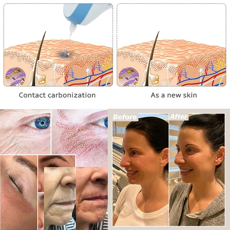 

Plasma Lift Plasma Pen Fibroblast Eyelid lifting Medical Skin Tattoo Mole Removal With 3 needles Face Skin Care Machine