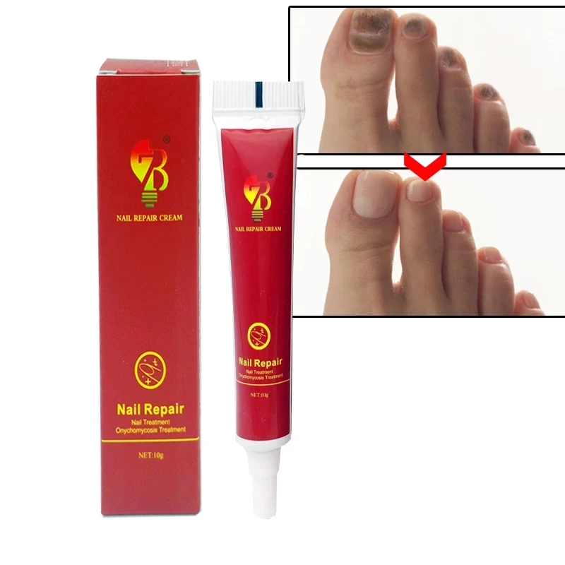 

10G High Quality Chinese Medicine Nail Cream Treatment Onychomycosis Anti Fungal Nail Infection Fights Bacteria Naturally Cream