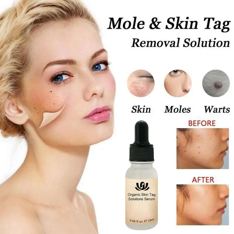 

20 ML Mole Skin Removal For Females Face Wart Tag Freckle Serum Painless Dark Oil Removal Spot Plaster F3Q7