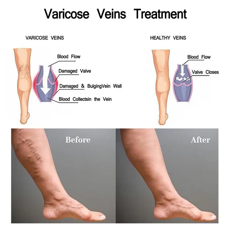 Набор для лечения варикозного расширения вен набор крем и ручка сисветильник |