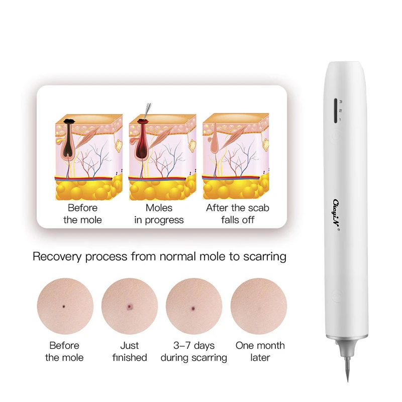 

Usb Mole Removal Pen Set Wart Plasma Remover Tool Skin Care Repair Freckle Dark Tag Nevus Sweep Spot Removal Device